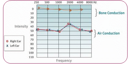 傳導性聽力損失