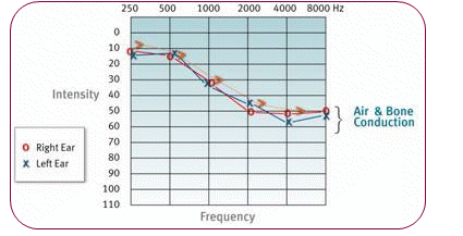 感音神經性聽力損失